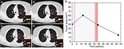 Abscopal Effects in Radio-Immunotherapy—Response Analysis of Metastatic Cancer Patients With Progressive Disease Under Anti-PD-1 Immune Checkpoint Inhibition